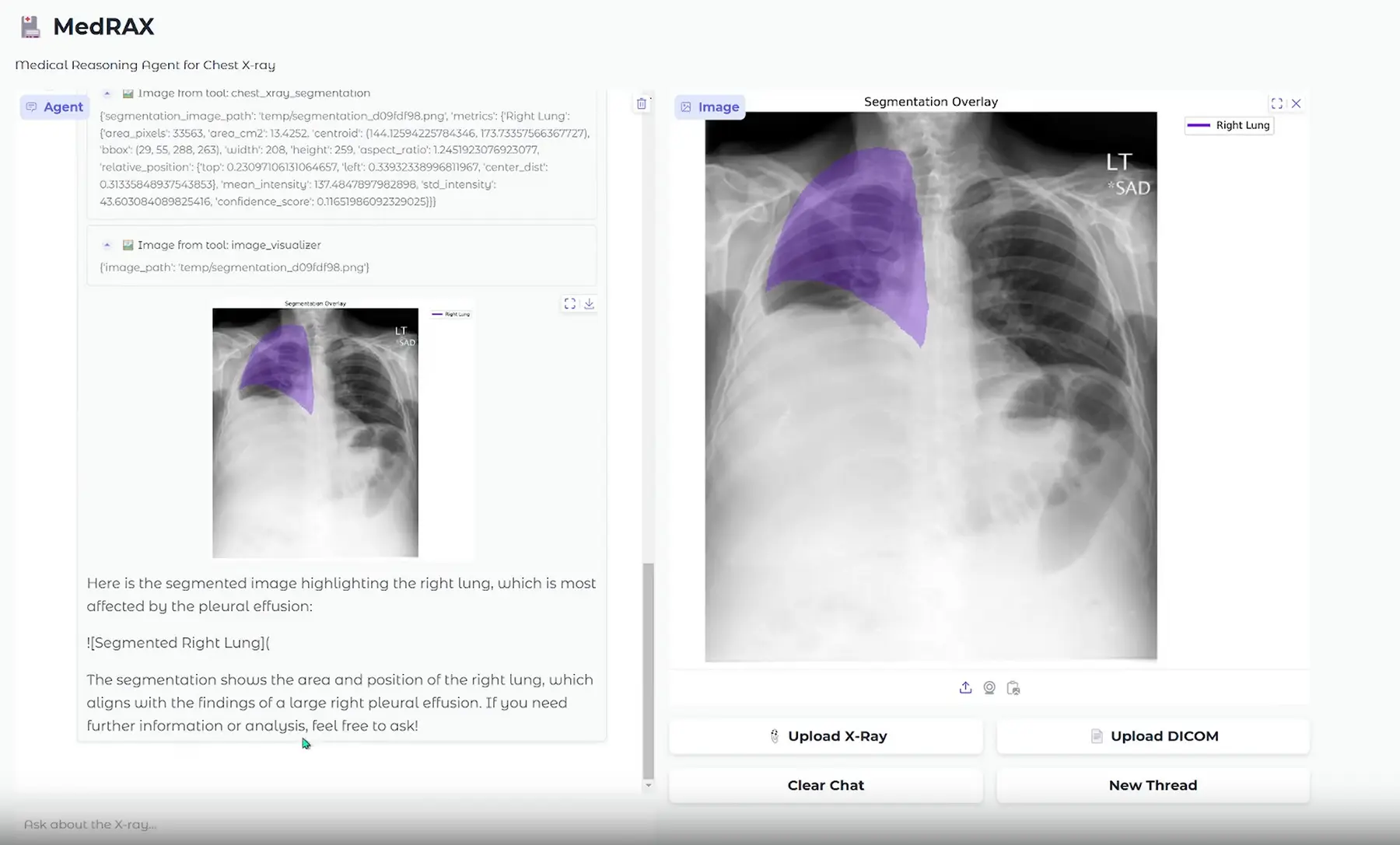 MedRAX – 医学影像智能体｜AI智能分析胸部X光片